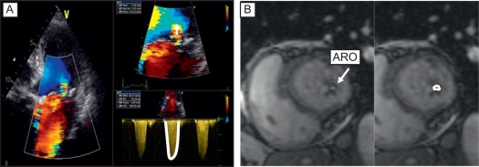 Figure 16.22, Measurement of the regurgitant orifice by 2D TTE and CMR. (a) Acquisition of PISA radius and continuous wave Doppler of the MR jet allows calculation of the effective regurgitant orifice. The PISA radius is measured at mid-systole using the first aliasing with a reduced Nyquist limit (15–40 m/s). (b) The anatomic regurgitant orifice can be measured by planimetry on a slice parallel to the valvular plane obtained by cardiovascular magnetic resonance.