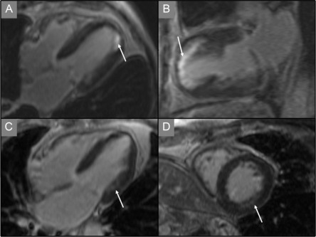 Figure 16.23, Different patterns of fibrosis on late enhancement (LE) CMR in primary mitral regurgitation. Arrows point at zones of late contrast enhancement on CMR, indicating the presence of fibrosis. (a and b) Infarct-like pattern in a 71-year-old male with moderate-to-severe MR due to prolapse of P2. This patient had normal coronary arteries on coronary angiography. (c and d) Late contrast enhancement in the lateral wall of a 72-year-old male with severe MR due to prolapse of P2.