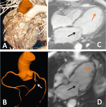 Figure 16.24, Patient with a history of anterior myocardial infarction, secondary MR and severe left ventricular remodeling. Three-dimensional (3D) cardiac computed tomography showing a significant left anterior descending artery stenosis (a and b, white arrows). Cardiac magnetic resonance demonstrated the presence of significant mitral valve deformation with a severe tenting (black arrows) and a large zone of myocardial scar tissue (orange arrows) (c and d).