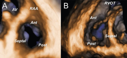 Figure 16.25, En face views of normal tricuspid valve anatomy by transthoracic three-dimensional echocardiography: atrial or surgical view (a); ventricular view (b). AV, aortic valve; RAA, right atrial appendage; RVOT, right ventricular outflow tract.