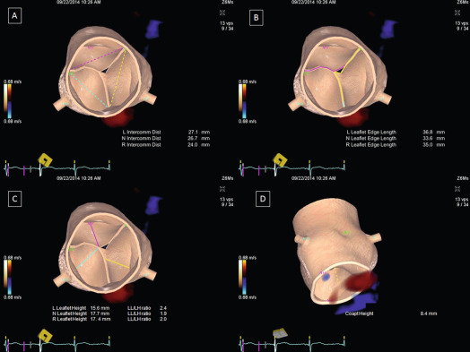 Figure 16.3, Automated quantitative modeling of the aortic root in aortic regurgitation. inter-commissural distance (A), leaflet free-edge length (b) and height (c) and their ratio, and co-aptation height can all measured.