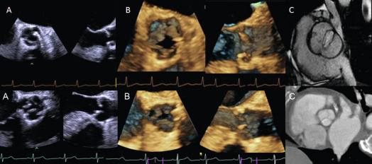 Figure 16.4, Illustrative examples of visualization of aortic valve (AV) morphology by 2-D TEE of mildly calcified AV (a, top) above and of significantly calcified AV (a, below). The corresponding 3-D TEE of the AV is shown in (b); note the dropouts in the leaflets in the example shown below. CMR shows the bicuspid valve morphology in (c) (top) without any calcium artifacts; the example below in (c), CT shows a 3-cuspid AV morphology. CT may be useful when it is performed primarily for CTA in AS to evaluate native or graft coronary anatomy.