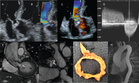 Figure 16.5, The role of CMR for sub-valvular AS. 2-D TTE (a–d) shows a linear echo-density on the LVOT (arrow) suggestive of a membrane, AR by color Doppler, and flow aliasing in the LVOT and across the AV in systole and a peak Doppler velocity of 4 m/s and AR. CMR shows the sub-aortic membrane in (e and f) in the long-axis and short-axis views of the LVOT and the AV. Furthermore, marked dilatation of the ascending aorta is seen in (h). In fact, the entire thoracic aorta can be evaluated (h), which is an important advantage of CMR. The pathologic specimen of the sub-aortic membrane removed during surgery is shown in (g).