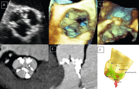 Figure 16.6, Echocardiography and CT of AV calcification in AS. In (a), 2-D TEE of calcium distribution in AS is shown in the short-axis view of the AV. 3-D TEE may be useful to examine the bulk of calcium (b and c), but significant calcification can cause dropouts in the image, and there is no method to quantify the calcium. Calcium amount and distribution is clearly depicted by CT in (c and d). This is valuable both to aid in the diagnosis of severe AS when hemodynamic data is uncertain or in cases of decision making for intervention in the setting of moderate–severe AS. Additionally, the pattern of distribution shown in D where the calcium protrudes into the LVOT is predictive of suboptimal positioning of the prosthesis during TAVR and consequent paravalvular leak.