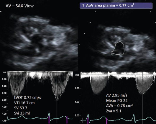 Figure 16.7, A 2-D Echo/Doppler echo of low-flow, low gradient, normal EF severe AS. The measured biplane EF was 61.2%, and there was moderate concentric LVH (wall thickness, 1.3 cm). The AVA by planimetry shown in the top panel was 0.77 cm 2 . The peak AV Doppler velocity and the mean gradient suggest only mild–moderate AS. The stroke volume index based on LVOT spectral Doppler and LVOT diameter was 33 ml, and the calculated ZVa was 5.1 indicative of severe AS. The calculated AVA by continuity equation was 0.78 cm 2 consistent with severe AS.