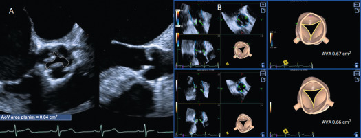 Figure 16.8, Planimetry of AV area by 2-D TEE (a) and 3-D TEE (b). In 3-D TEE, the anatomic landmarks of the aortic root are automatically identified from which a quantitative 3-D model is obtained. The automated 3-D AV area from two cardiac cycles are shown, and they are similar at 0.67 and 0.66 cm 2 . Note that the 2-D planimetry shows a larger AV area, which may be due to not using the 2-D plane at the tips of the aortic leaflets.