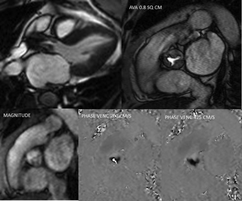 Figure 16.9, An example of phase contrast CMR for AS. Magnitude and phase images are shown in the panel below. When maximum velocity is set at 200 cm/s, the phase images show aliasing, whereas when it is set at 425 cm/s, there is no aliasing. The peak velocity was 4.1 m/s, and the AVA by planimetry was 0.8 cm 2 .