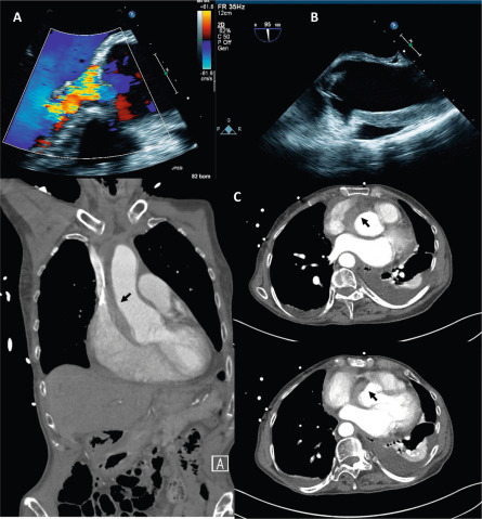 Figure 16.10, An example of AR secondary due to aortic root and ascending aorta hematoma. The upper panel (a) shows 2-D TEE CFD of AR, and hematoma (b). The extent of hematoma is better visualized by CT, extending from the root to the arch (black arrows in c).