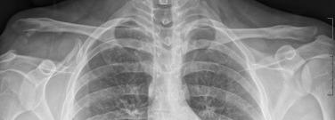 • Fig. 35.1, Right grade V acromioclavicular joint injury with a greater than 100% increase in the coracoclavicular distance compared with the contralateral side.