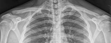 • Fig. 35.2, Left grade VI acromioclavicular joint injury with inferior displacement of the clavicle in relation to the acromion.