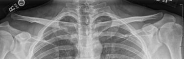 • Fig. 35.3, Right grade III acromioclavicular joint injury.