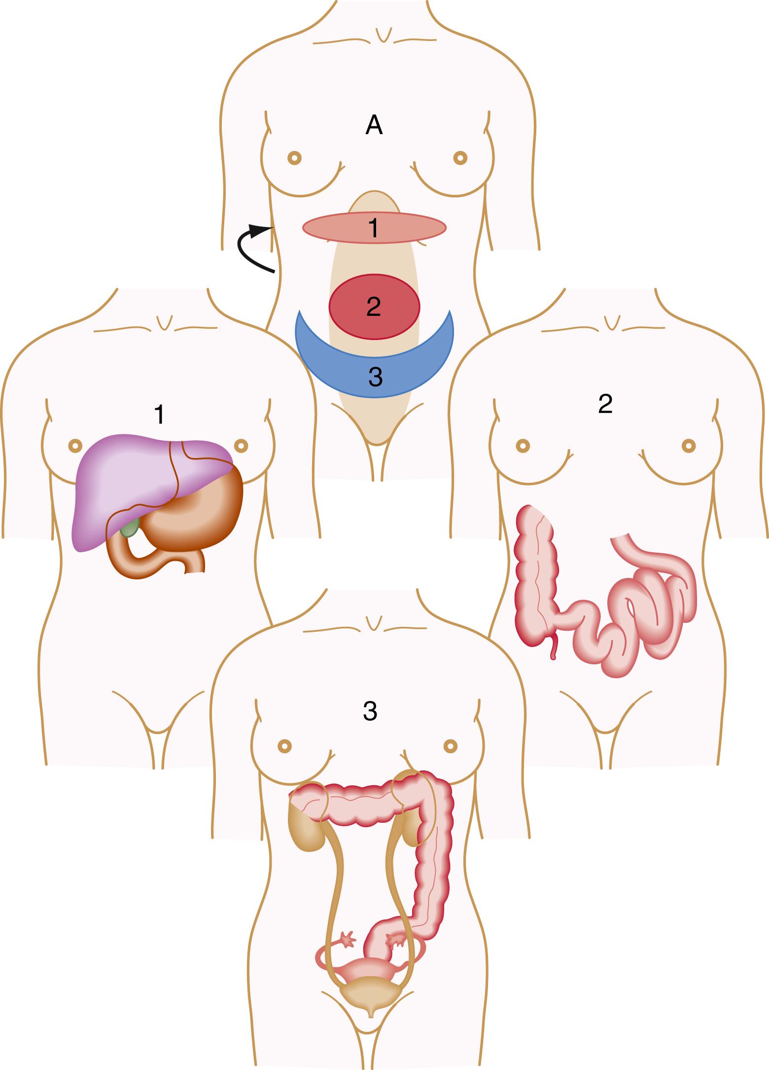 Fig. 11.3, Localization of visceral pain. Pain arising from organ areas depicted in 1 , 2 , and 3 is felt in the epigastrium, midabdomen, and hypogastrium, respectively, as shown in A . The arrow in A indicates biliary pain that is referred to the right scapular area.