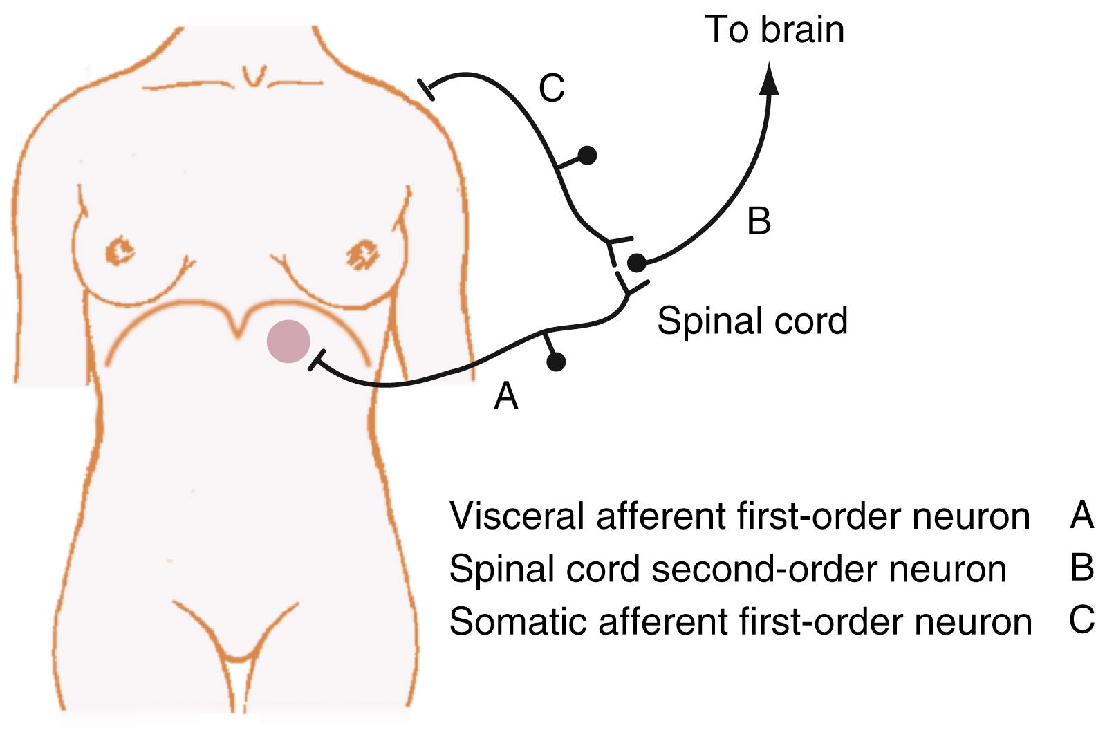 Fig. 11.4, The neuroanatomic basis of referred pain. Visceral afferent fibers that innervate the diaphragm can be stimulated by local irritation (e.g., subdiaphragmatic abscess [circle] ). These visceral afferent fibers (A) synapse with second-order neurons in the spinal cord (B) as well as somatic afferent fibers (C) arising from the left shoulder area (cervical roots 3 to 5). The brain interprets the pain to be somatic in origin and localizes it to the shoulder.