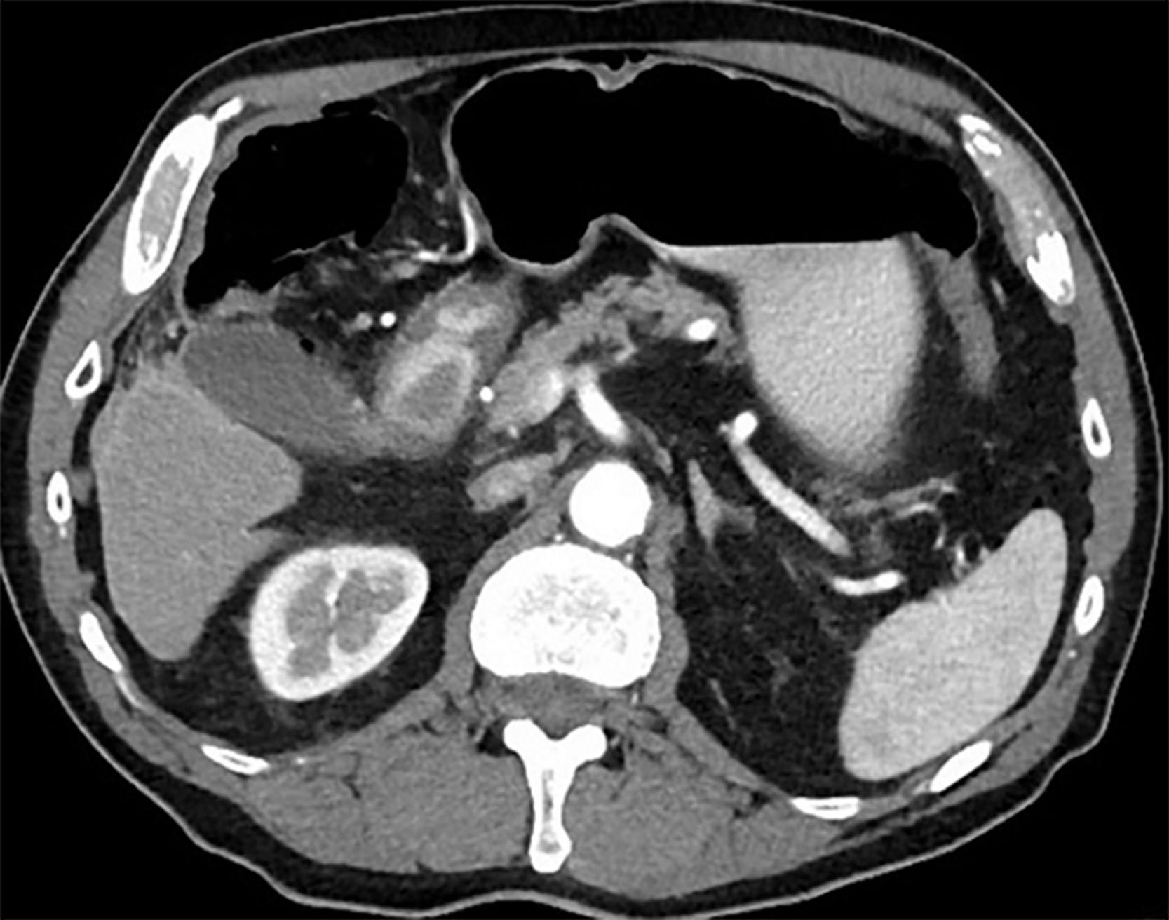 Fig. 53.1, CT abdomen without contrast showing free air in the abdomen (pneumoperitoneum)