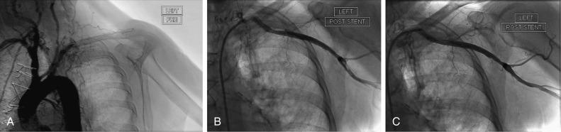 Fig. 44.1, In Situ Thrombosis of Subclavian Artery in a Patient Presenting With an Inferior ST-Segment Elevation Myocardial Infarction and Symptoms of Acute Left Arm and Hand Ischemia.