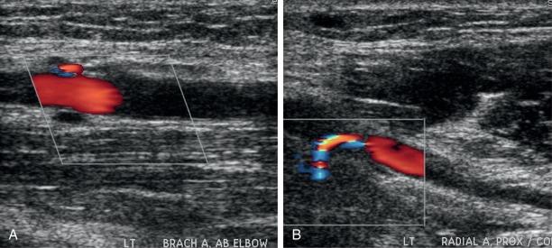 Fig. 44.2, Acute Hand Ischemia After Coronary Angiography via Left Brachial Artery Access.