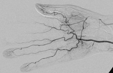 Fig. 44.3, Embolic occlusion of the right radial artery and ischemia of the index and middle fingers in a patient with a patent foramen ovale.