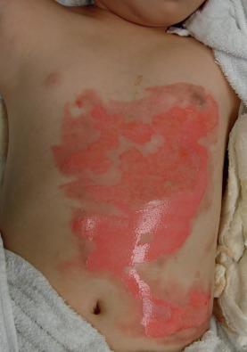 Fig. 4.1.1, An example of a second-degree burn.