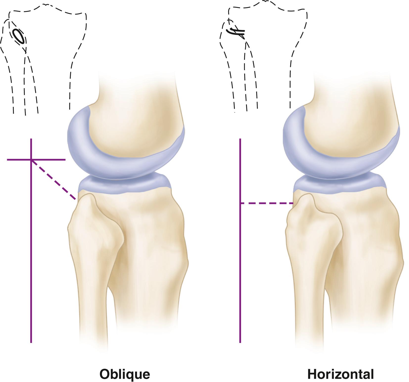 FIGURE 60.7, Two basic types of proximal tibiofibular joints according to Ogden.