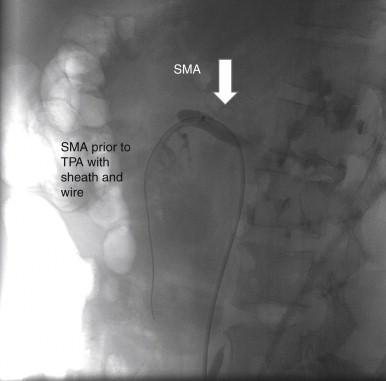 FIGURE 1, Acute embolus to the superior mesenteric artery (SMA) (arrow) in a patient who came to the hospital with severe abdominal pain but without intestinal infarction. TPA, tissue plasminogen activator.