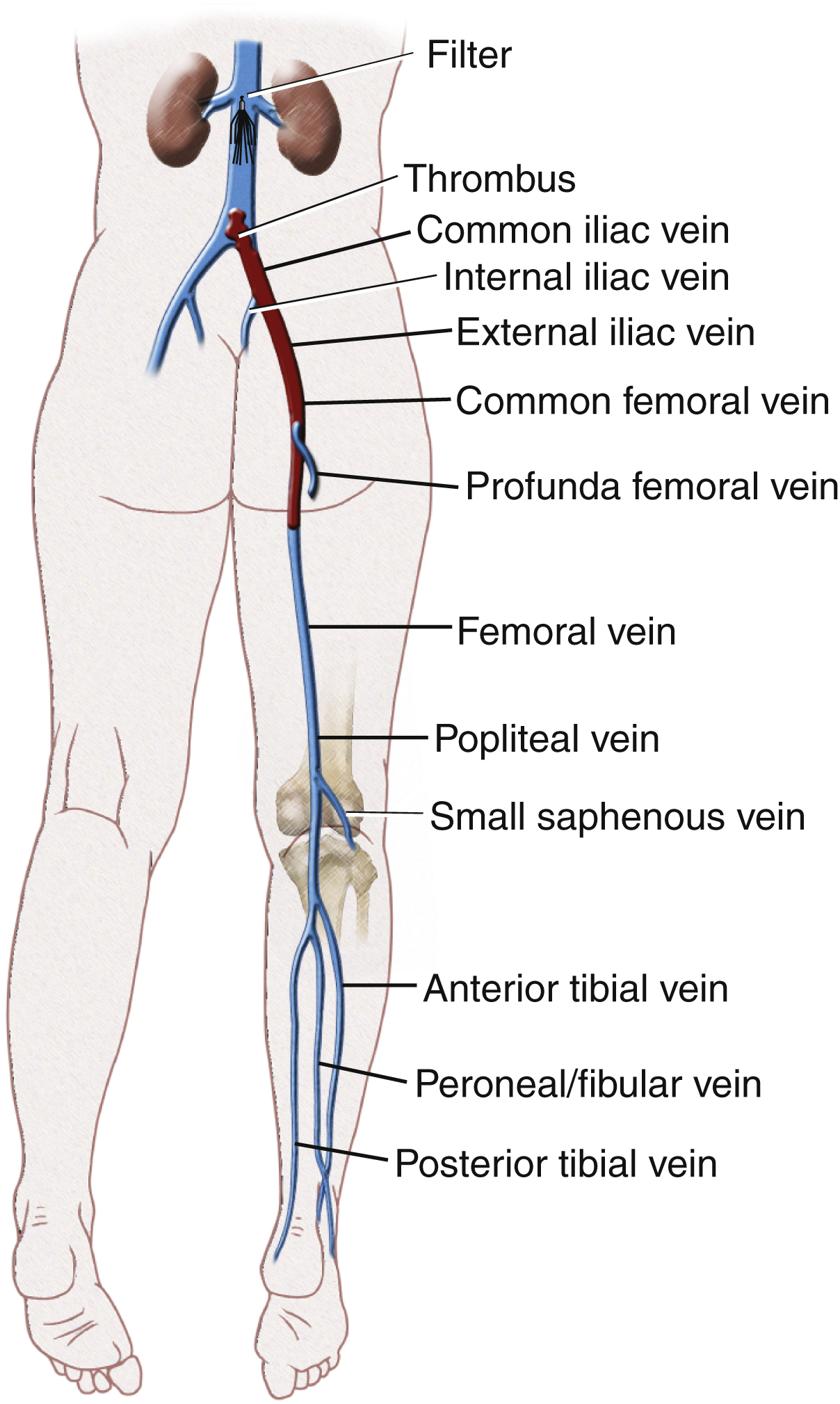 Fig. 70.1, Diagram of prone patient with thrombosis of right common iliac, external iliac, common femoral, and proximal veins. Thrombus extends into inferior vena cava as a “free-floating” thrombus. A filter has been placed infrarenally.
