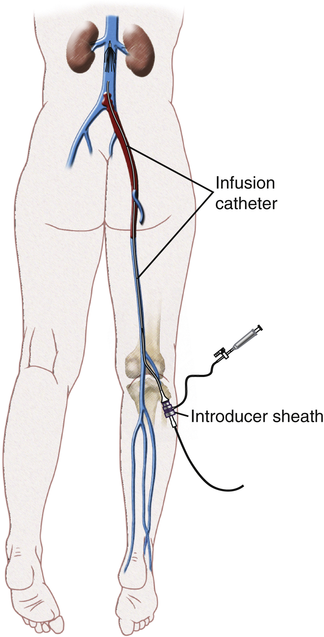 Fig. 70.2, Diagram showing placement of an introducer sheath into patent popliteal vein. Infusion catheter has been advanced across entire thrombosed segment. Heparin can then be infused through introducer sheath as thrombolytic agent is infused through infusion catheter.