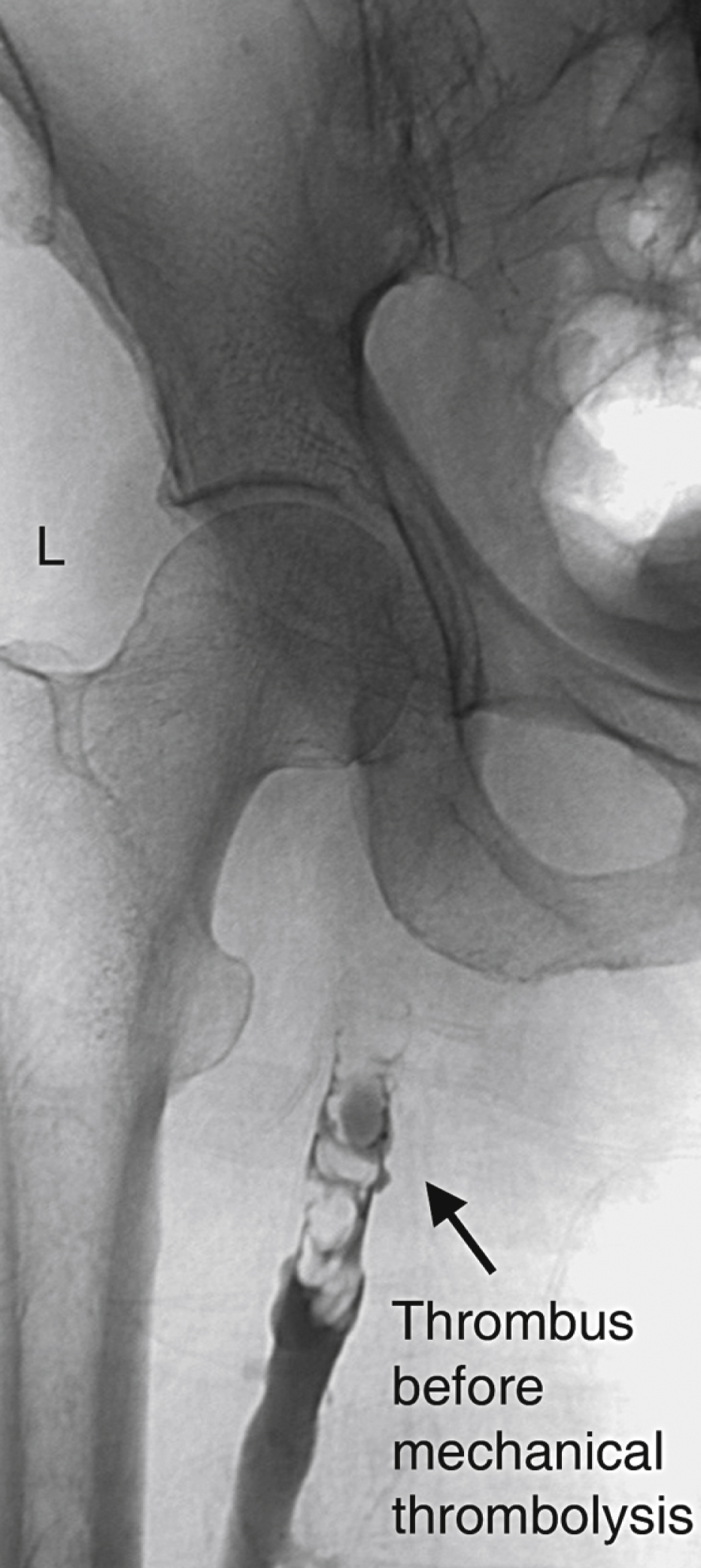 Fig. 70.3, Patient with left-sided ( L ) proximal femoral-to-common iliac vein thrombus. Access has been gained into popliteal vein and contrast medium injected from below, showing thrombus filling proximal portion of femoral vein.