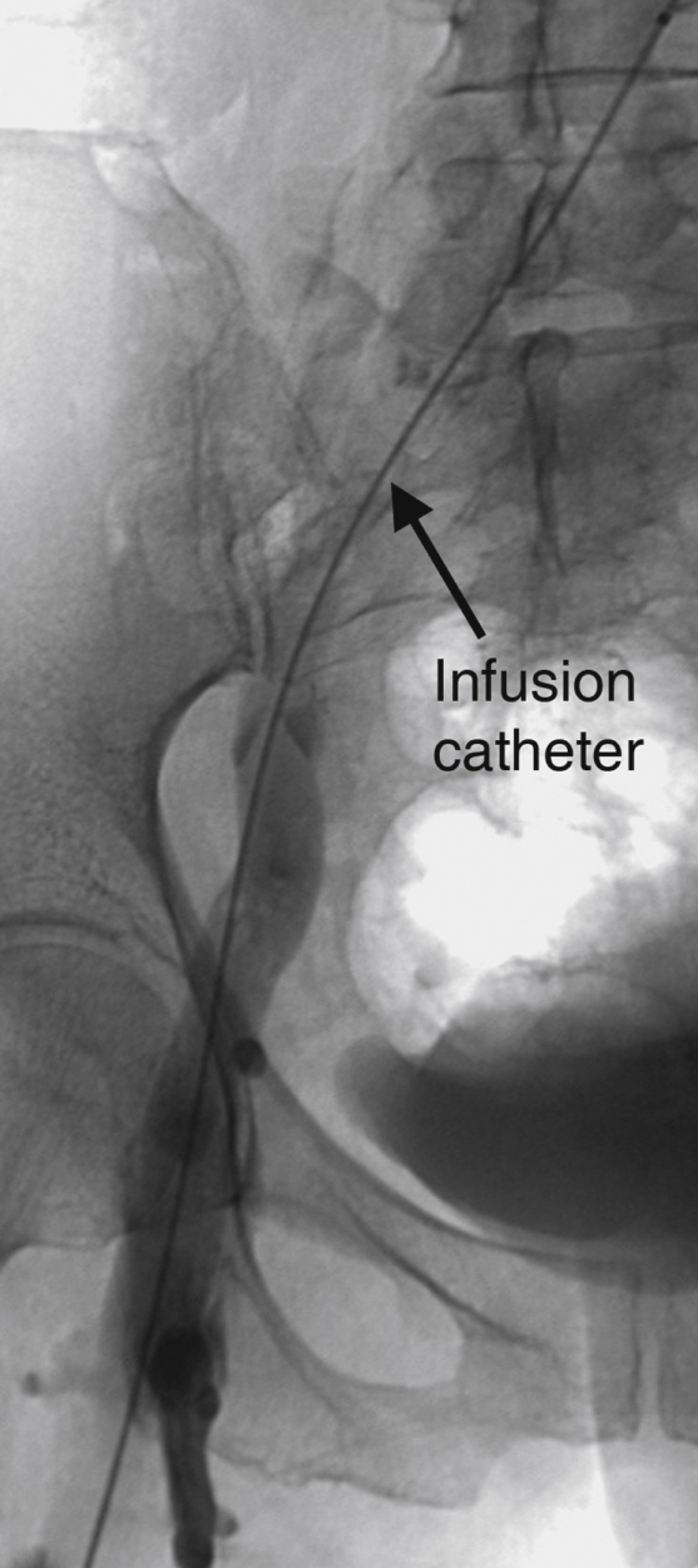 Fig. 70.4, After mechanical thrombectomy, femoral, common femoral, and external iliac veins are almost cleared of thrombus. Thrombus remained in common iliac vein, and an infusion catheter was left in place and thrombolytic therapy initiated. Infusion catheter covers previously thrombosed segment as well as remaining thrombus.