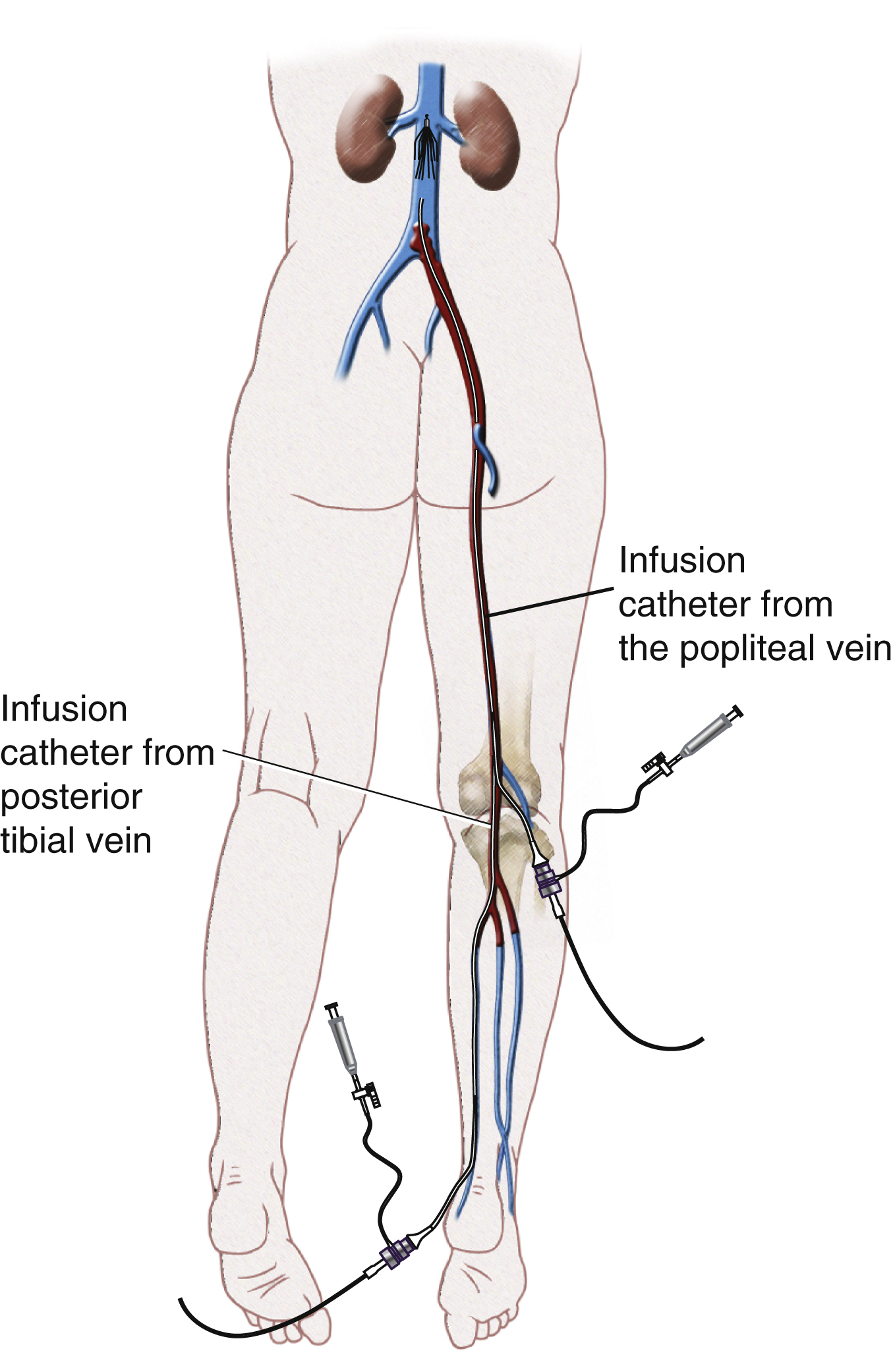 Fig. 70.5, In this case, thrombus extends distal to femoral and popliteal veins into calf veins. Access has been gained to posterior tibial vein via ankle, and an introducer sheath has been placed there. Infusion catheter has been placed. Infusion catheter should overlap with infusion catheter already in place from popliteal vein.