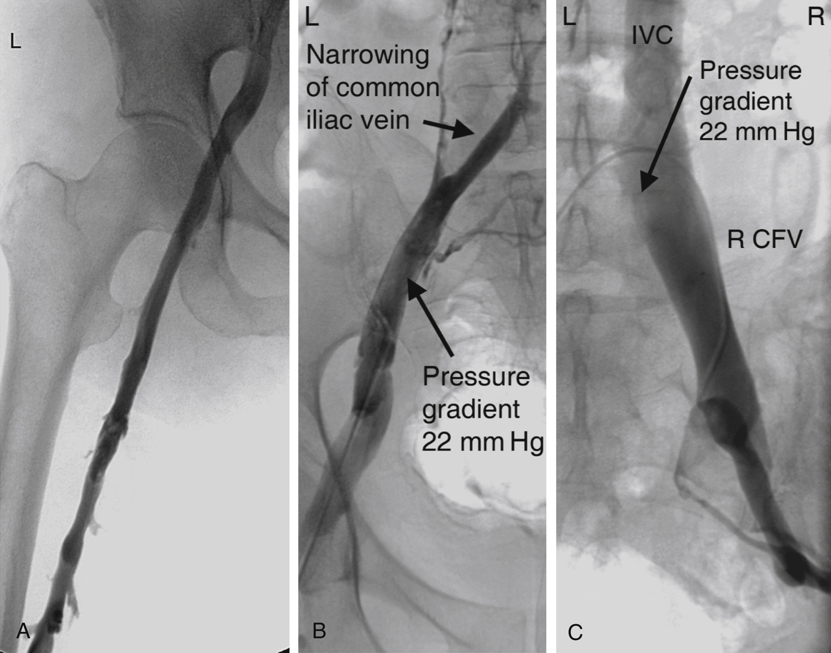 Fig. 70.6, Venogram obtained after 18 hours of thrombolytic infusion. (A) Open femoral, common femoral, and external iliac vein, but there is a long segment of common iliac vein narrowing (B) that probably is part of May-Thurner syndrome. (C) Catheter has been passed into contralateral (right) iliac system, and pressure measured there is compared with pressure in left iliac vein peripheral to narrowed segment. Pressure difference (gradient) was 22 mmHg. IVC, Inferior vena cava; R CFV, right common femoral vein.