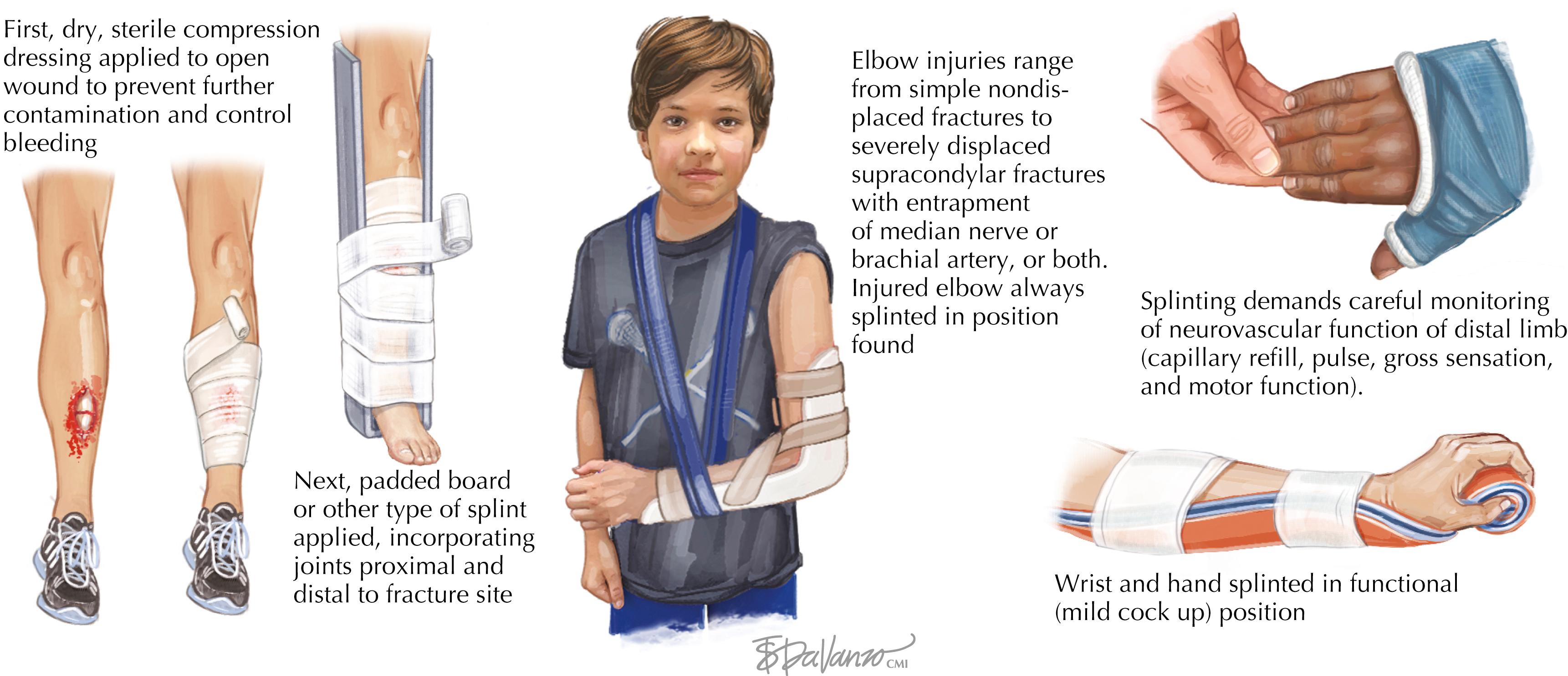 Figure 58.1, Prehospital care of fractures.