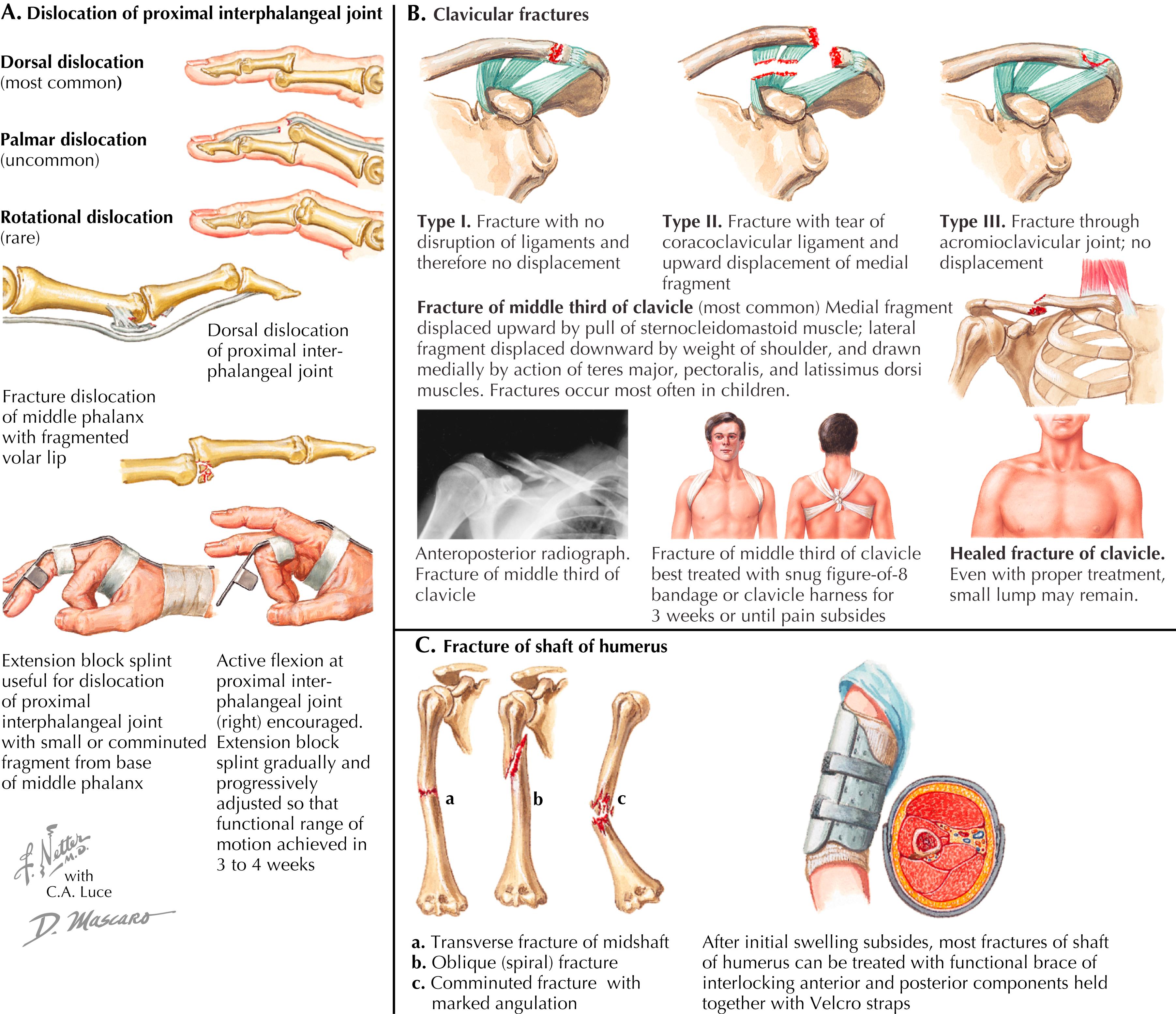 Figure 58.2, Upper extremity fractures and dislocations (proximal interphalangeal, clavicle, and humeral shaft).