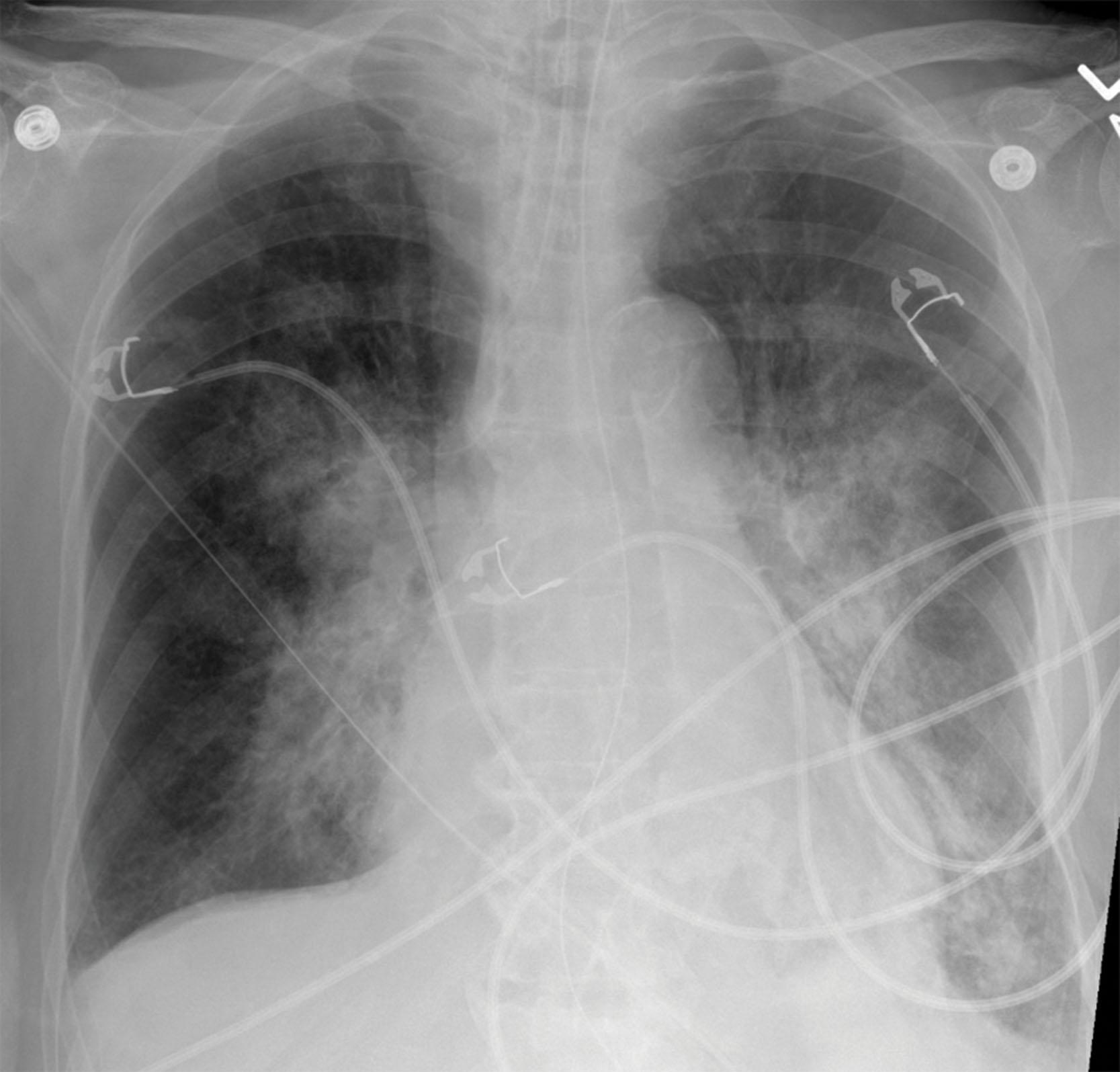 Fig. 22.1, Chest X-ray with bibasilar pneumonia, consistent with aspiration pattern. Also visible are an endotracheal tube in place, nasogastric tube in place, and multiple cardiac monitor chest leads.