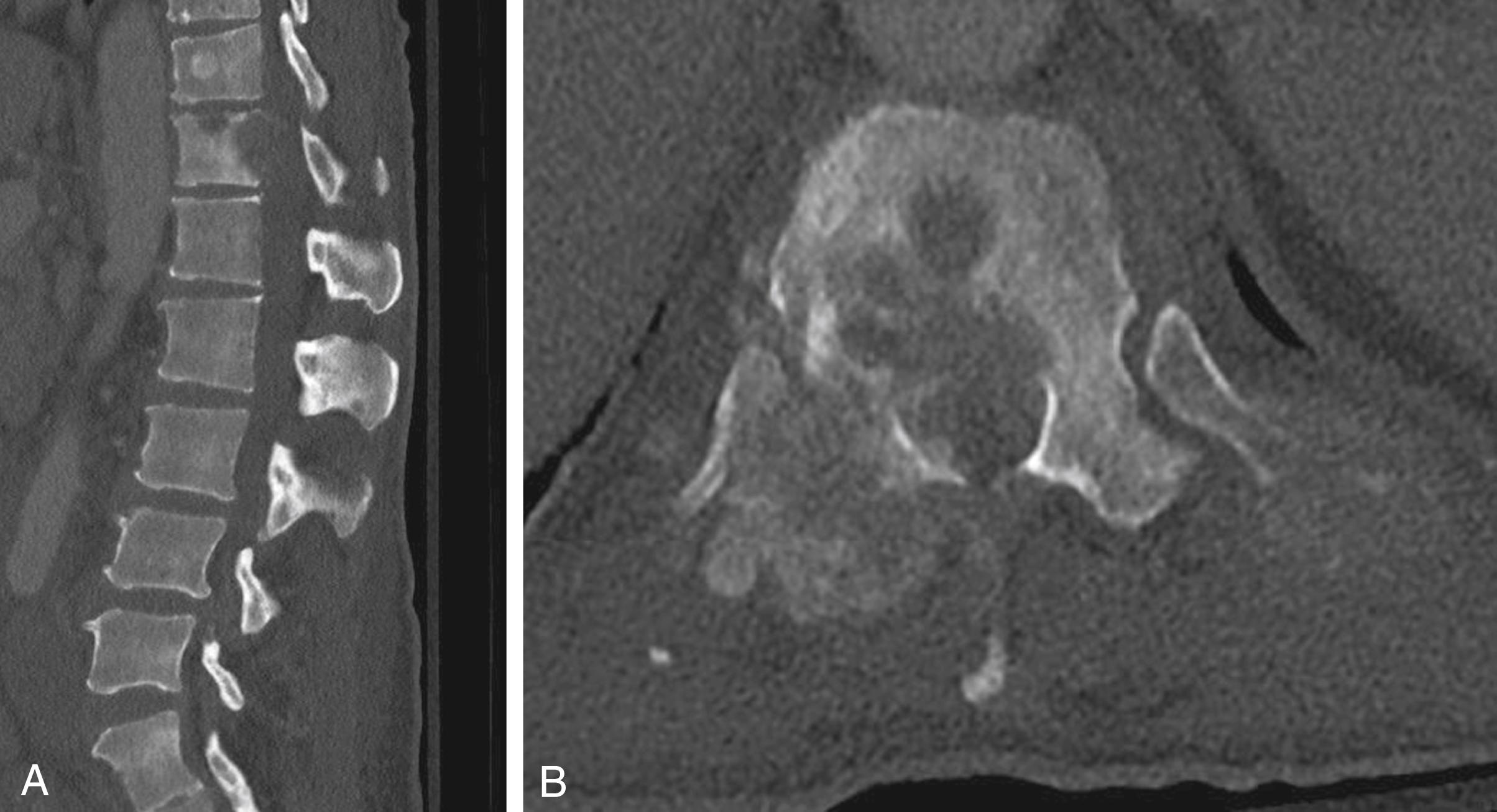 Fig. 42.1, A. Sagittal thoracolumbar CT without contrast demonstrates lytic lesions of the T12 vertebral body with normal alignment. There is no evidence of vertebral body collapse. There are diffuse intraosseous lesions throughout the spinal column (not pictured). B. Axial view demonstrates extraosseous extension of the T12 lesion into the ventral aspect of the spinal canal with involvement of the posterior elements (right worse than left).