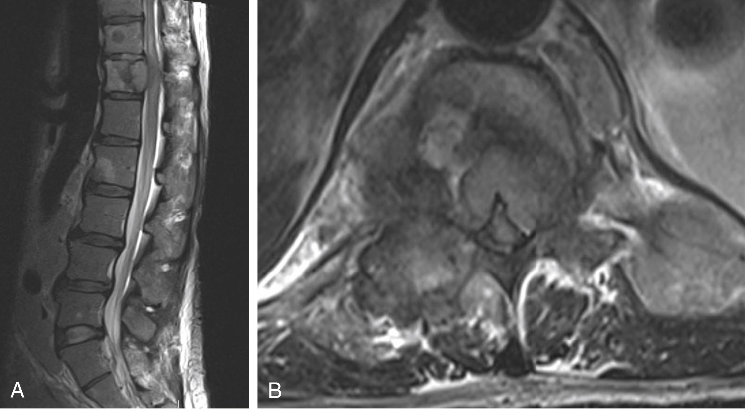 Fig. 42.2, A. Sagittal T2-weighted MRI of the thoracolumbar spine without contrast demonstrates an expansile lesion at T12 with posterior epidural extension. There is cord signal change at T11-T12 and multiple intraosseous lesions throughout the thoracolumbar spine. B. An axial sequence at T11-T12 demonstrates circumferential epidural cord compression with no evidence of CSF surrounding the cord.