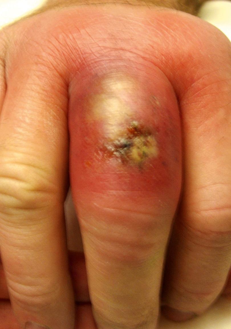 Fig. 2.1, Characteristic appearance of MRSA infection with central skin necrosis and surrounding erythema. Purulence is not always present. Soft tissue necrosis is often more extensive than would be expected from a localized infection.