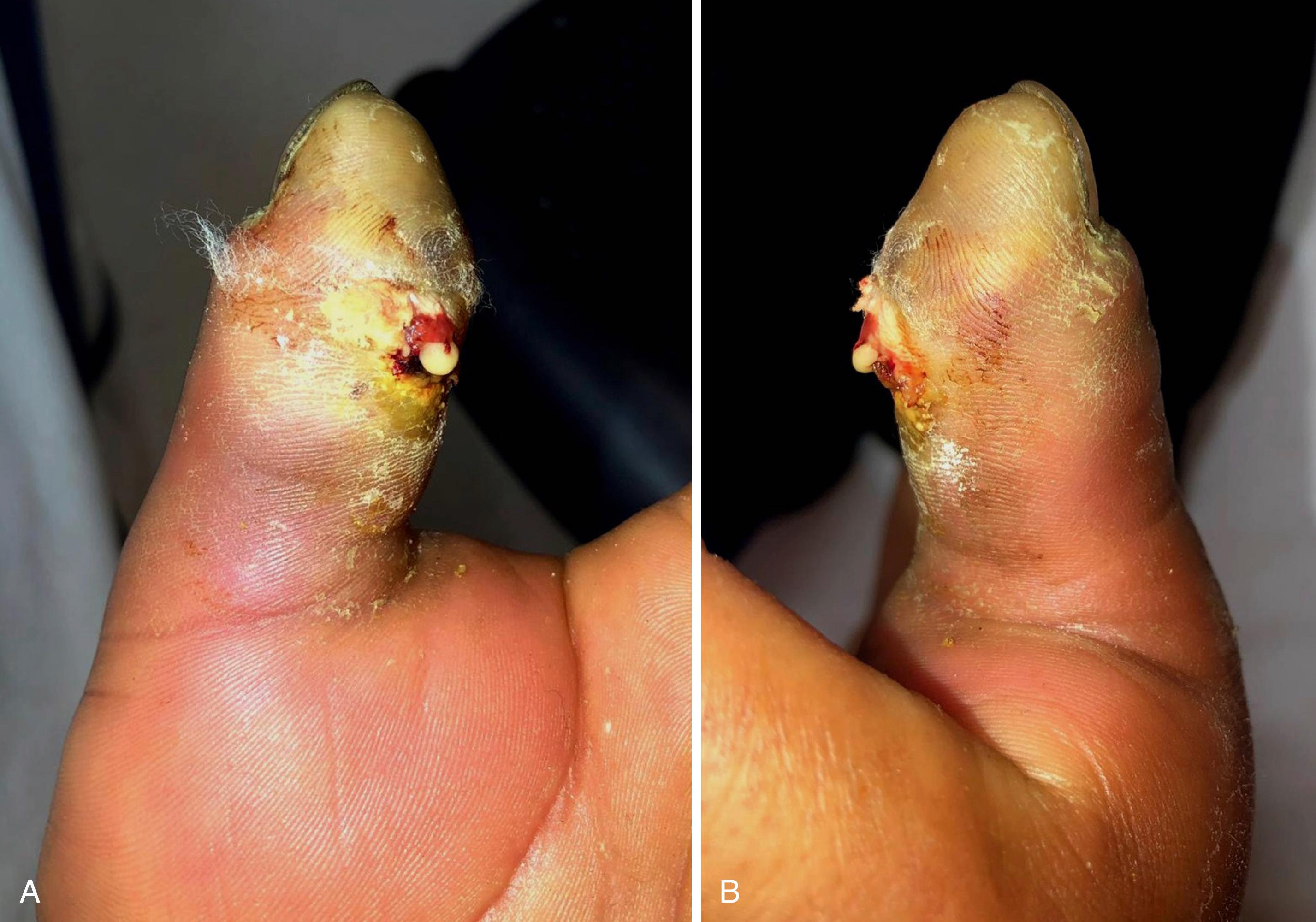 eFig. 2.4, A and B, Initial appearance of the thumb at presentation.