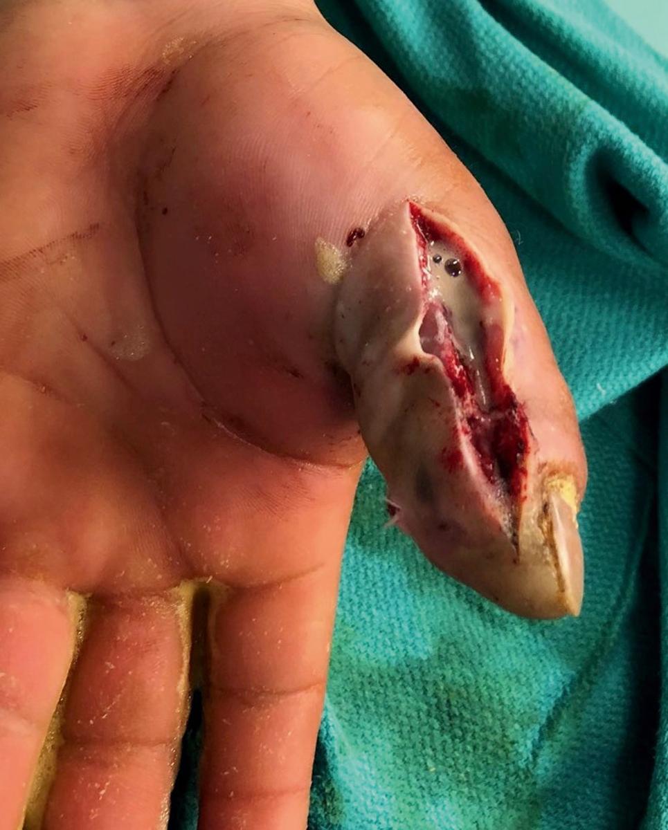 eFig. 2.5, Intraoperative findings at first debridement included proximally tracking purulence, a necrotic appearing pulp, and soft bone of the distal phalanx. No purulence noted in the thenar space.