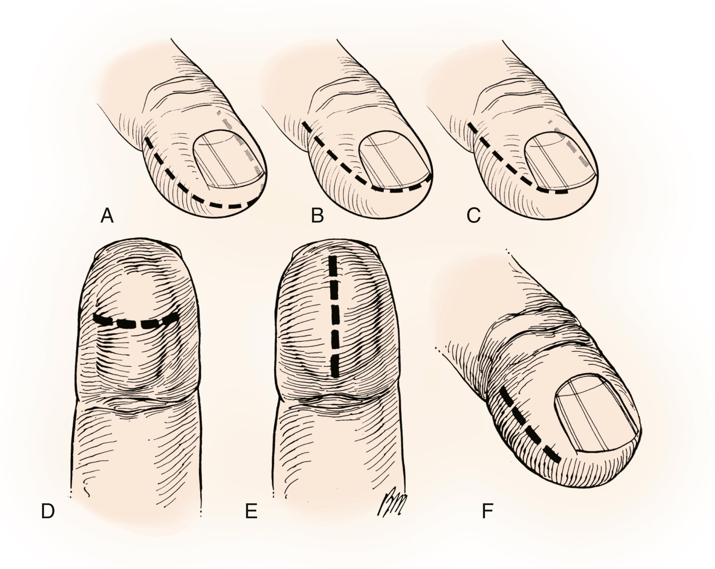 Fig. 2.10, Incisions for drainage of felons. A, Fish-mouth incision. This approach is associated with significant complications and should not be used. B, Hockey-stick incision. The incision begins in the midaxial line, aims for the corner of the nail, and passes across the finger in the natural line between the skin and nail matrix (see text discussion). C, Abbreviated hockey-stick incision with counterincision on the opposite side. An alternative to the full hockey-stick incision is to make this incision shorter and make a second incision on the opposite side of the pulp (faint dotted line) . D, Volar drainage is useful if the abscess points volarward, but this incision risks injury to the digital nerves. E, Alternative volar approach. There is less risk to the digital nerves, but the incision should not touch or cross the DIP joint flexion crease. F, Unilateral longitudinal approach. This incision is the authors’ preferred method for treatment of most felons.