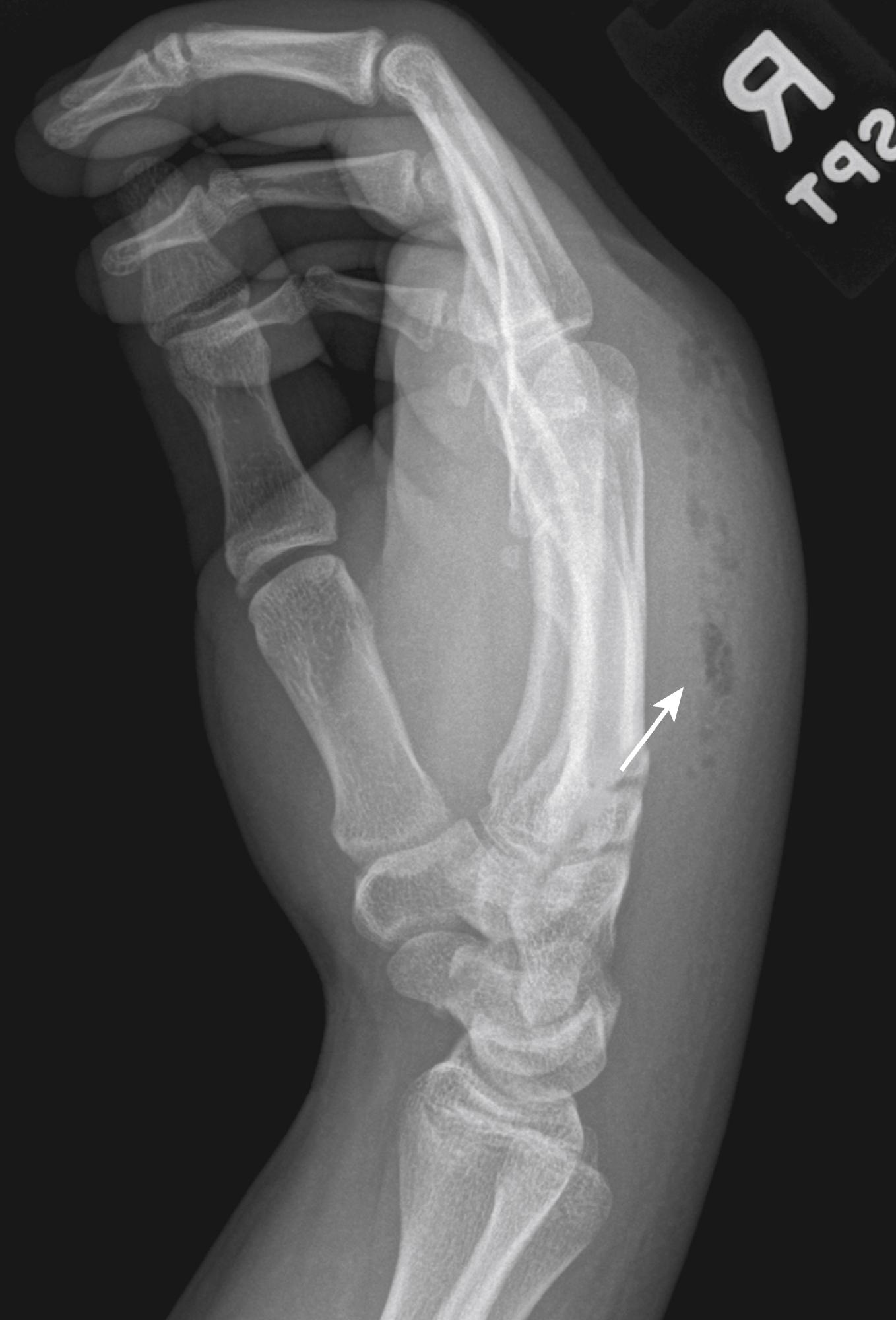 Fig. 2.2, Subcutaneous gas in a patient presenting with dorsal hand swelling with a bite wound (clenched fist injury) after wound closure at an outside emergency department.