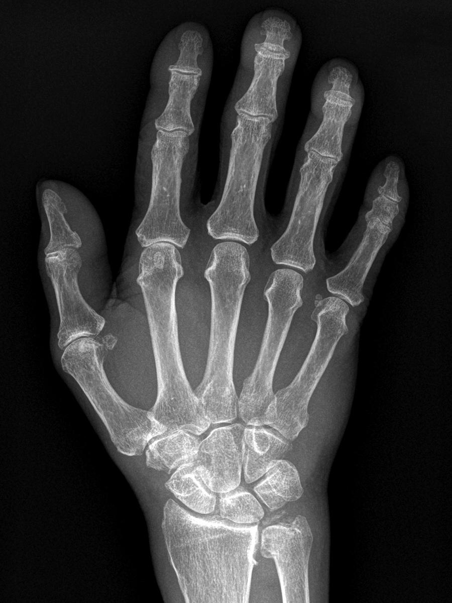 eFig. 2.1, Radiograph of the wrist demonstrating calcification of the triangular fibrocartilage complex (TFCC).