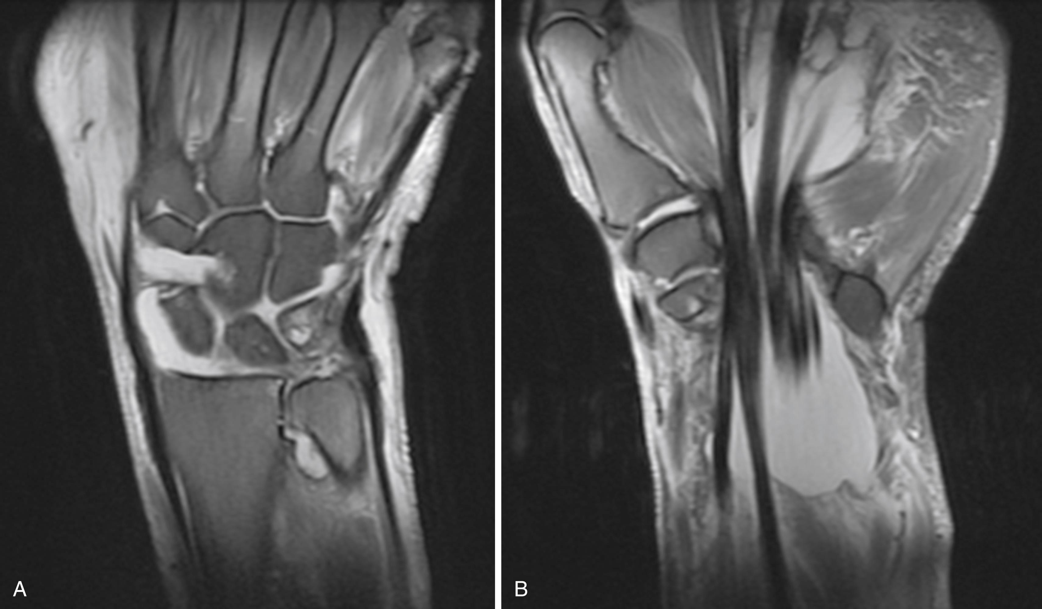 eFig. 2.2, A and B, Coronal MRI imaging showing fluid in all three compartments of the wrist and within the flexor tendon sheaths.