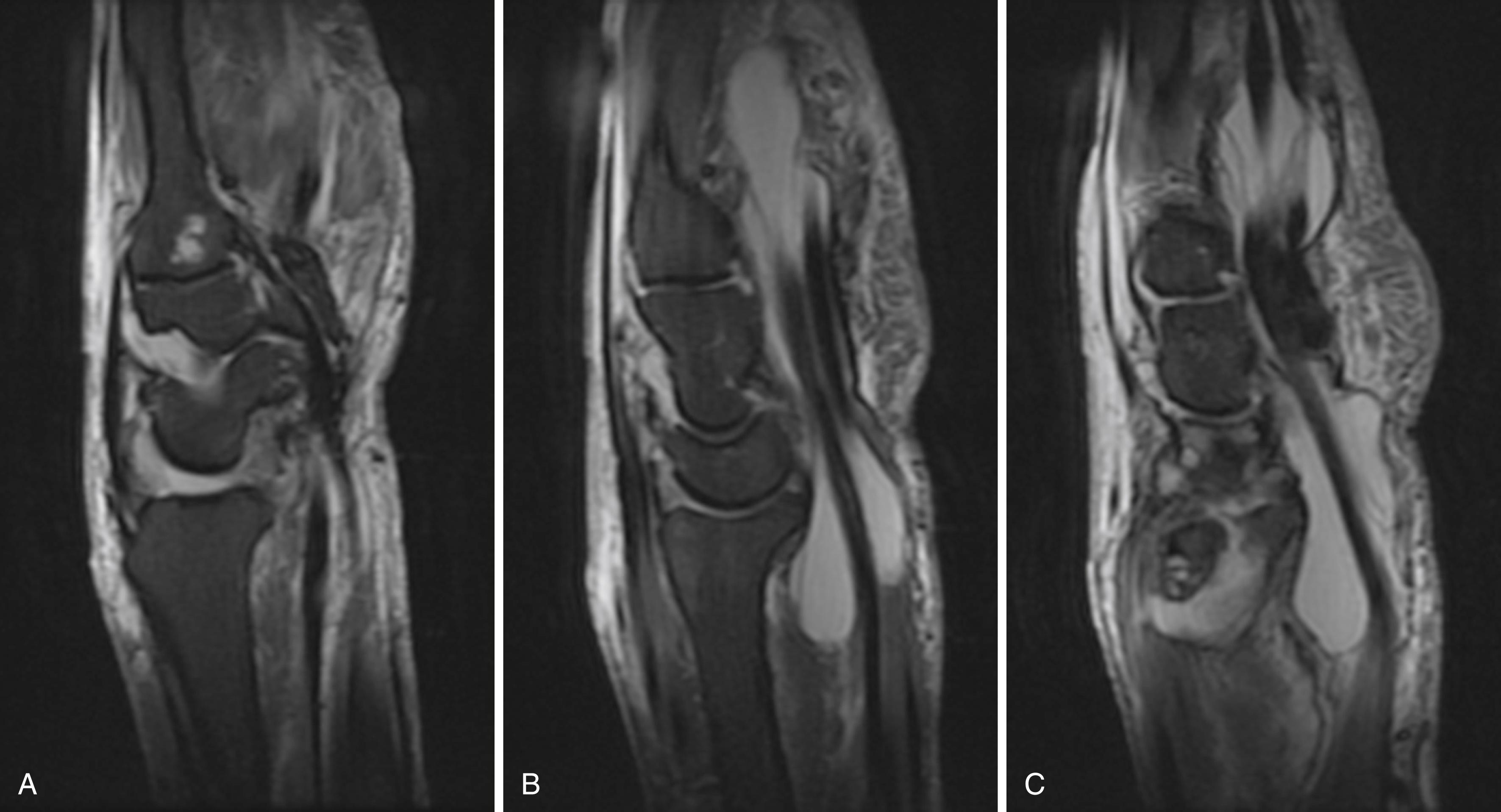 eFig. 2.3, A to C, Sagittal MRI imaging showing fluid in all three compartments of the wrist and within the flexor tendon sheaths.