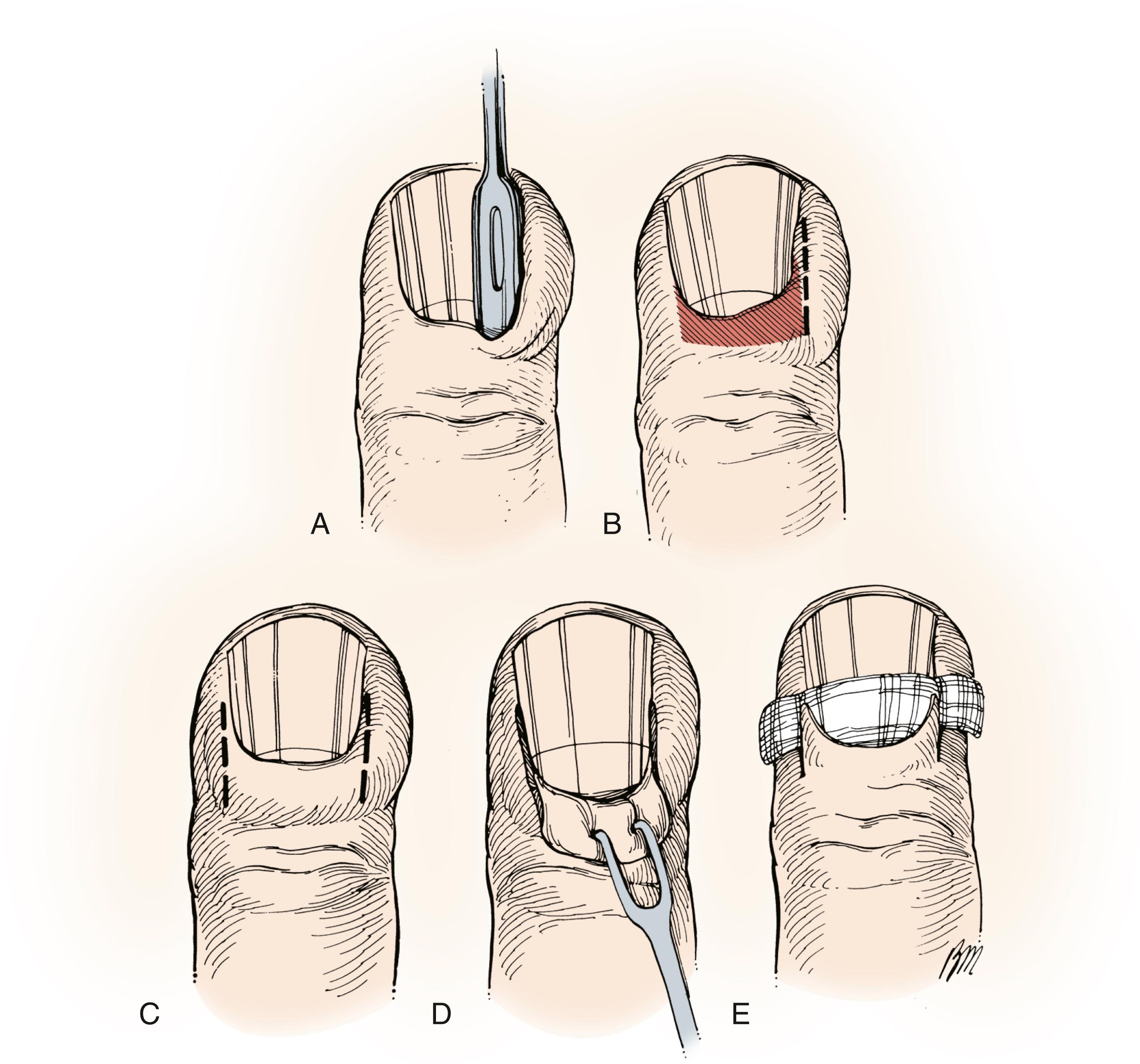 Fig. 2.5, A, Elevation of the eponychial fold with a flat probe to expose the base of the nail. B, Placement of an incision to drain the paronychia and elevate the eponychial fold for excision of the proximal third of the nail. C to E, Incisions and procedure for elevating the entire eponychial fold with excision of the proximal third of the nail. A gauze pack prevents premature closure of the cavity.