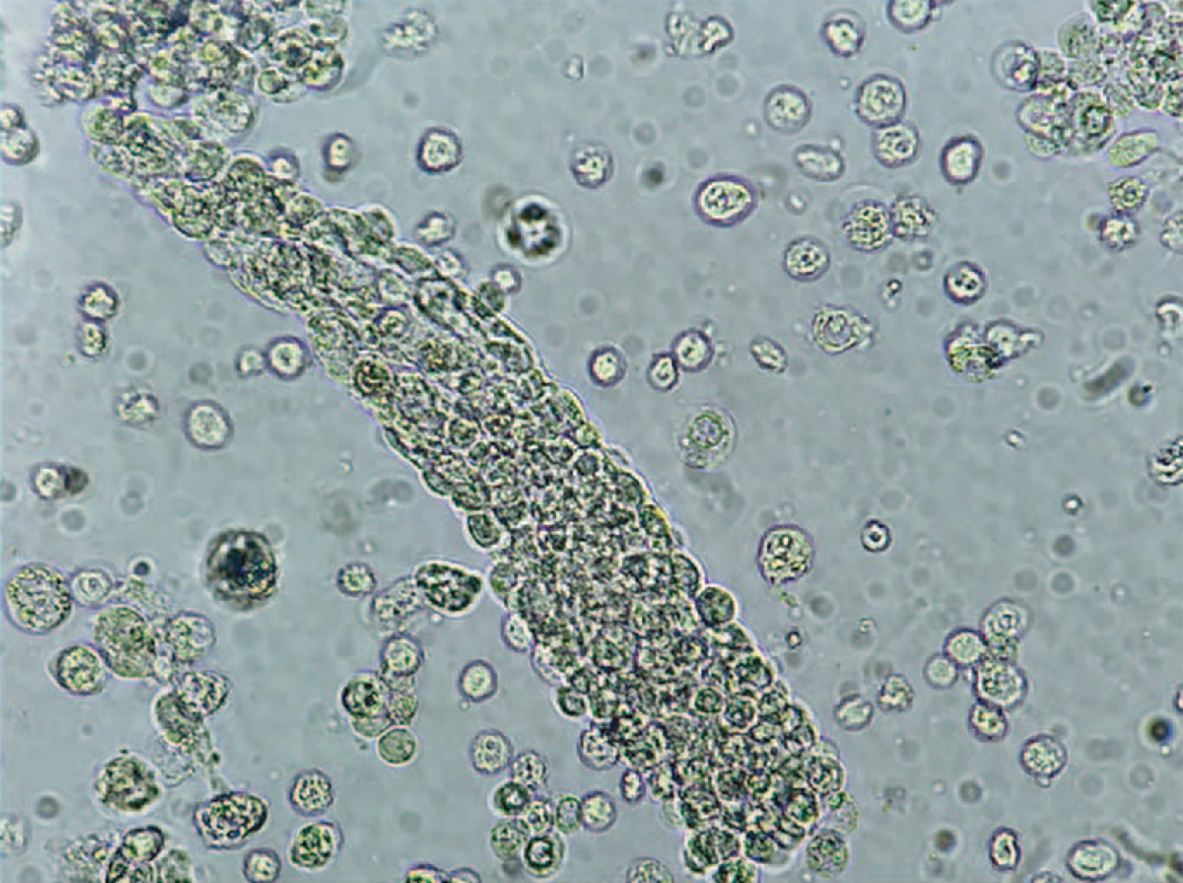 Fig. 33.1, Urine microscopy showing a white blood cell cast and surrounding white blood cells (× 60).