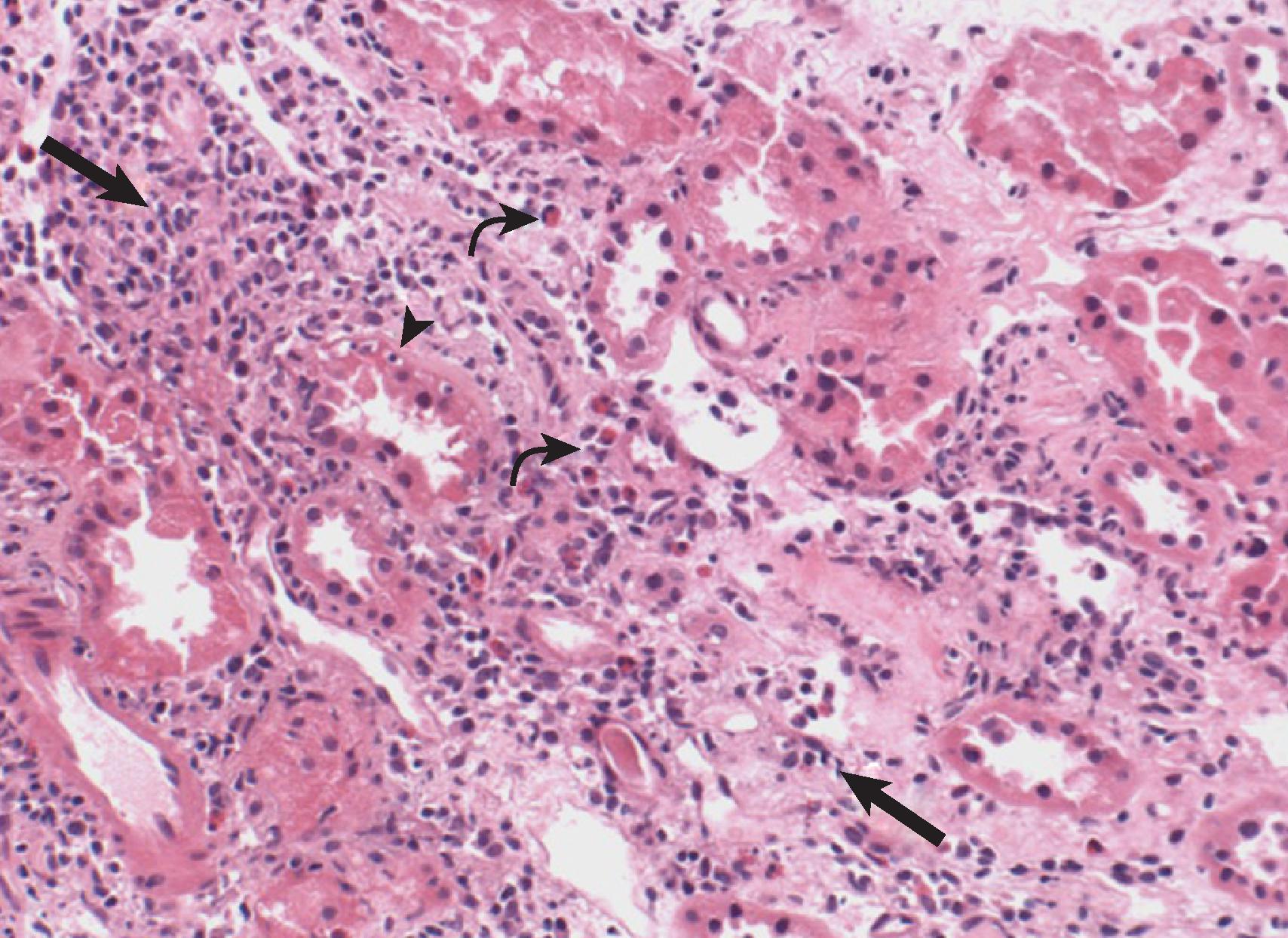 Fig. 33.2, Kidney biopsy showing acute interstitial nephritis. A diffuse interstitial infiltrate is present (arrows) along with severe tubular injury and tubulitis (arrowhead) , where lymphocytes have crossed the tubular basement membrane. Also present are eosinophils (curved arrows) (hematoxylin and eosin ×40).