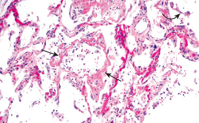 Fig. 30.1, Acute interstitial pneumonia: histologic findings. Micrograph shows hyaline membranes (straight arrows) and enlarged alveolar lining cells (curved arrow), typical of diffuse alveolar damage (hematoxylin-eosin, 200×).