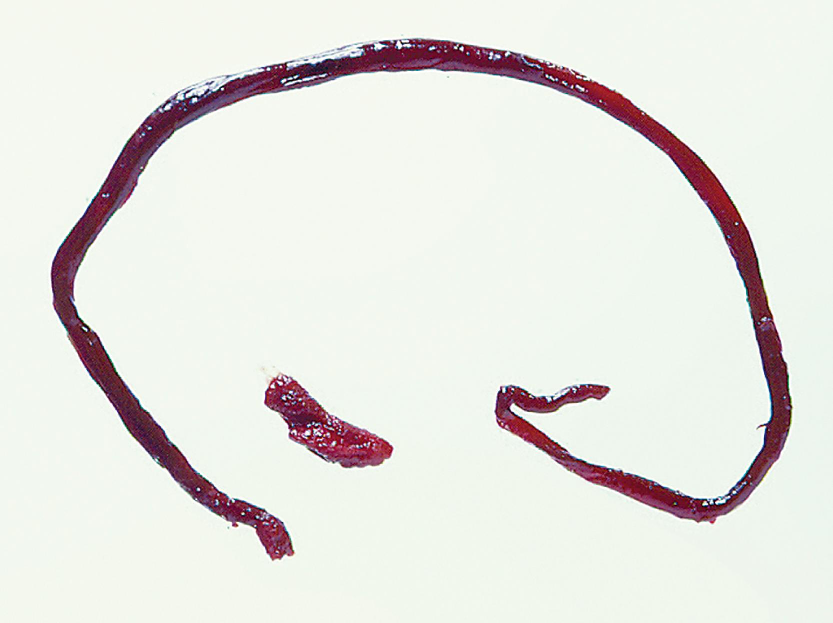 Figure 103.1, Embolic fragment in the center of the image, with the tail of secondary thrombus shown around it.