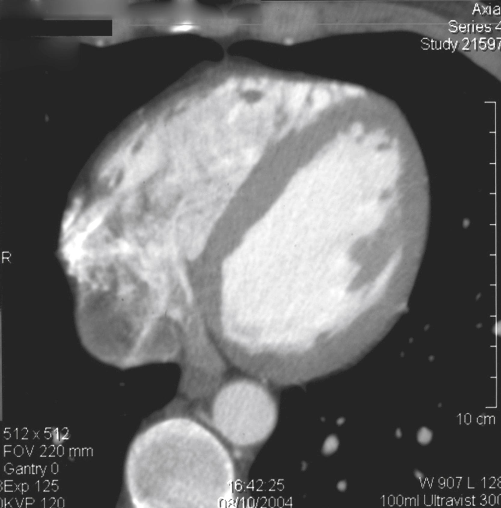 Figure 103.2, Computed tomogram of the heart showing mural thrombus that caused brachial embolus (same patient as in Fig. 103.9).