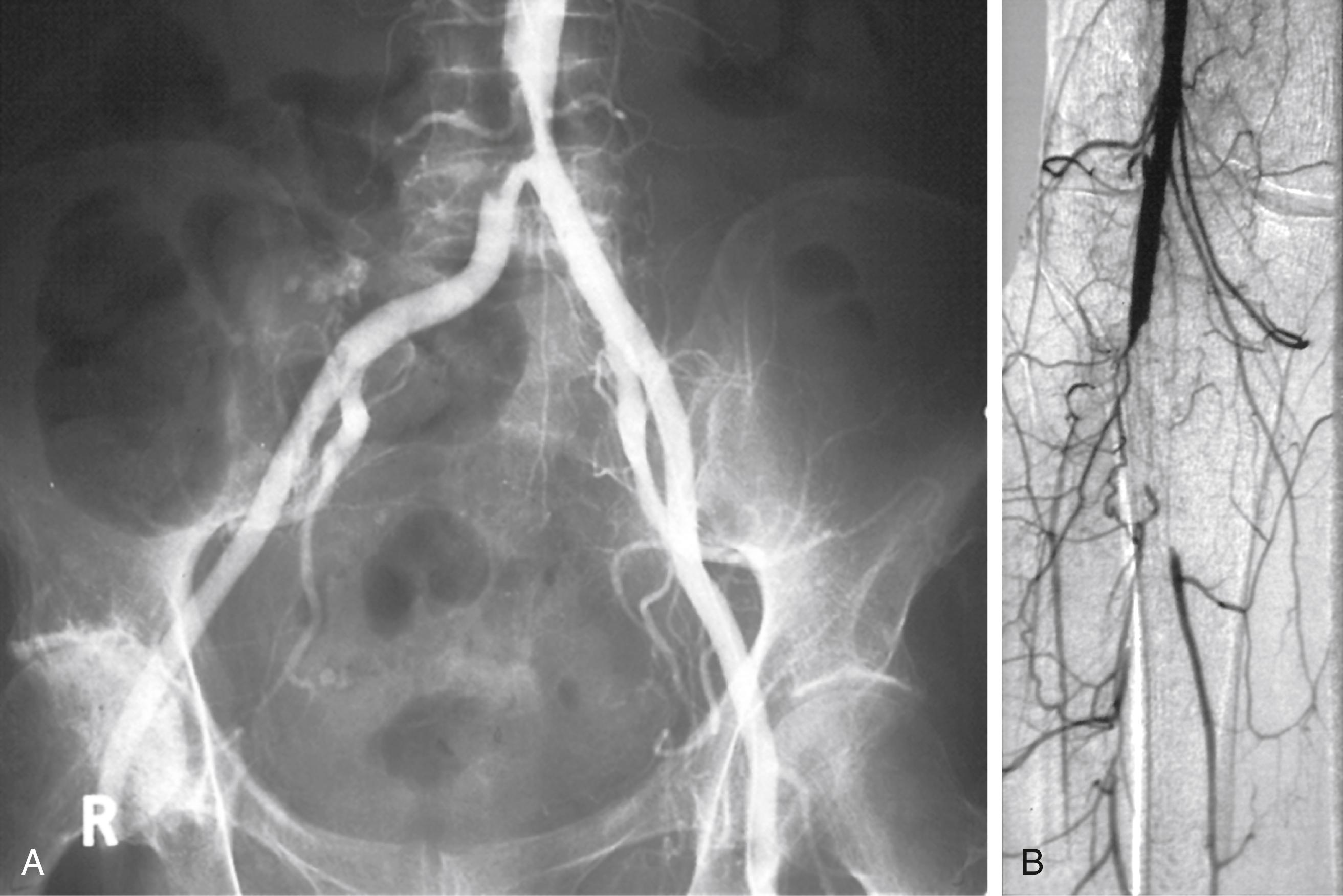 Figure 103.4, Angiogram showing aortic plaque ( A ) causing distal popliteal thromboembolism ( B ).